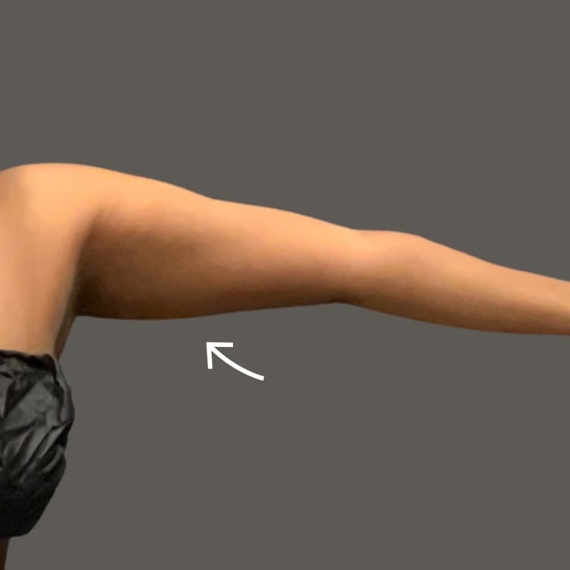 after airsculpt