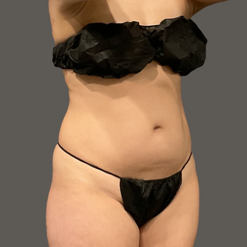 Stomach before airsculpt
