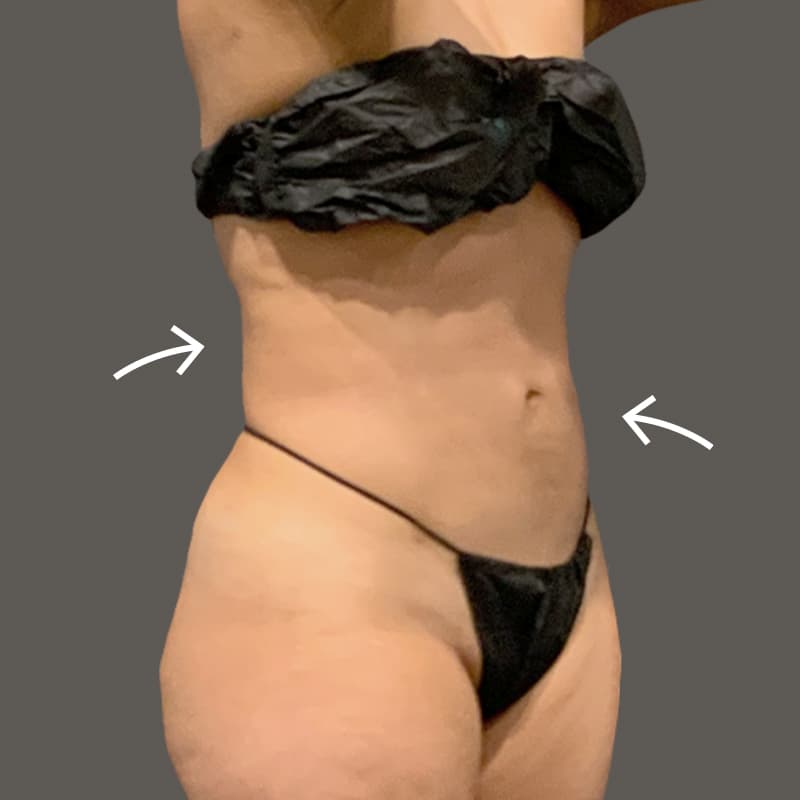 Stomach after airsculpt
