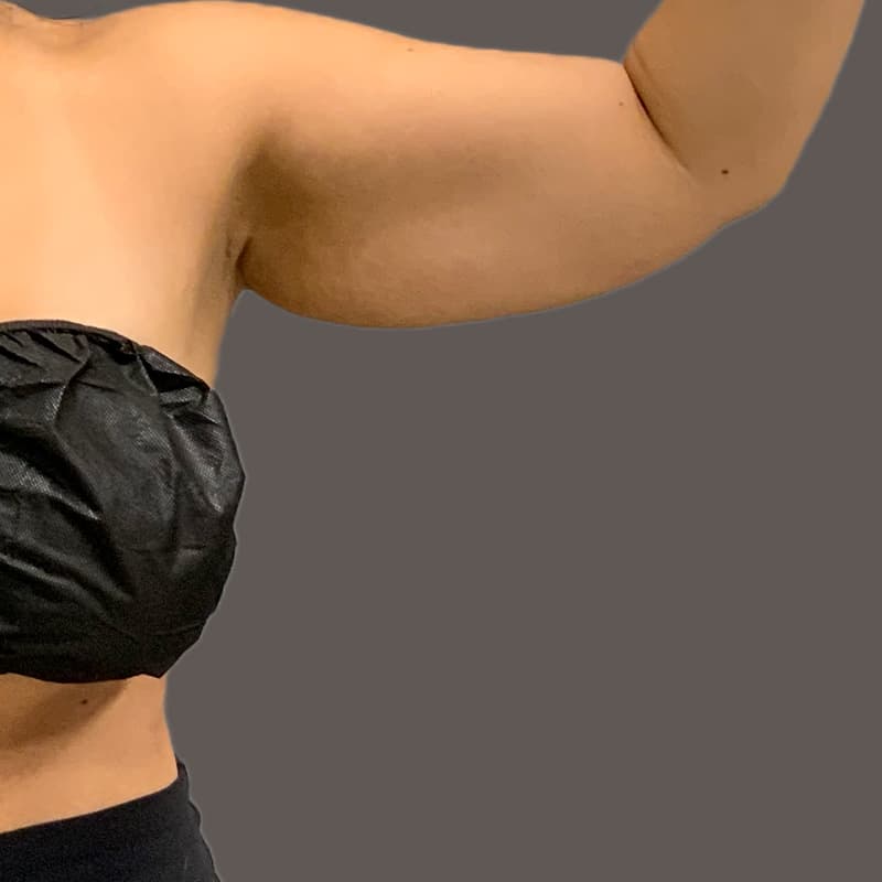 Arm before airsculpt
