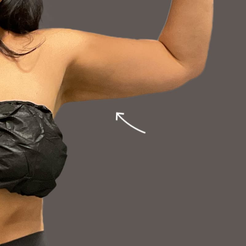 Arm after airsculpt