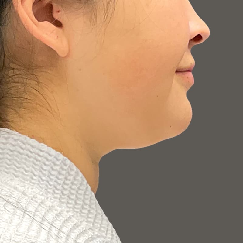 Chin before airscultp