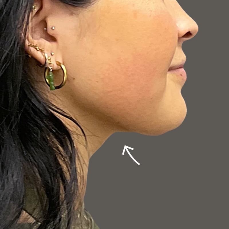 Chin After AirSculpt