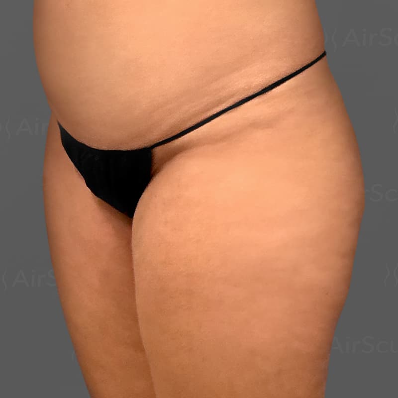 Fat Transfer - BBL before