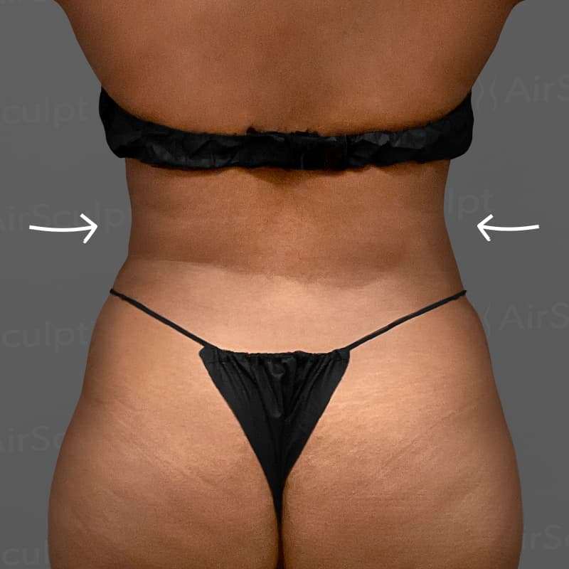Back AirSculpt after