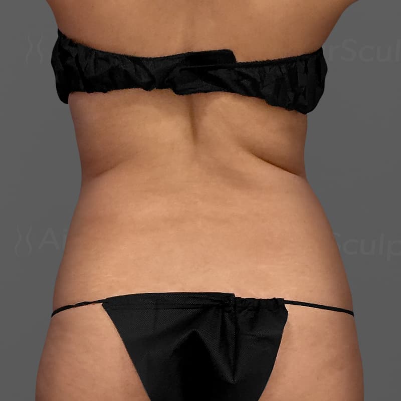 Back AirSculpt+ before
