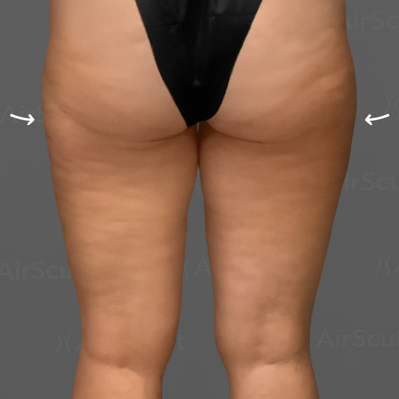 Thighs AirSculpt+ after