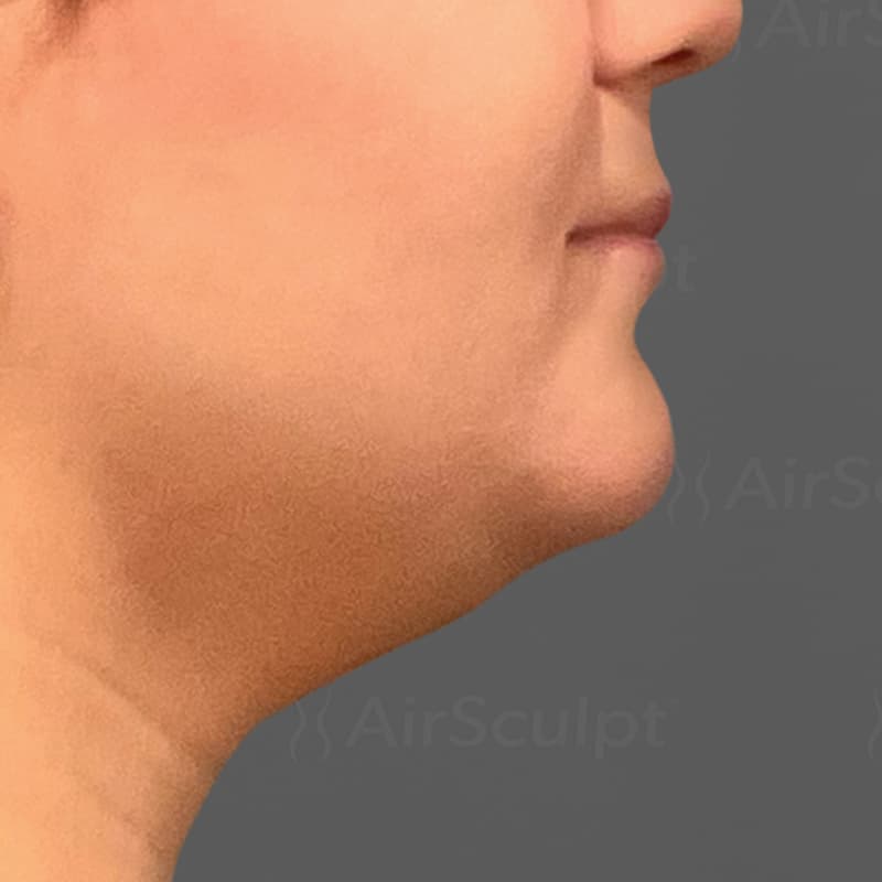 Chin AirSculpt before