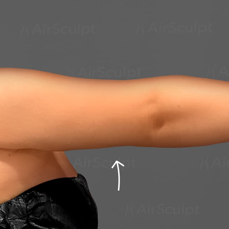 Arm AirSculpt+ after