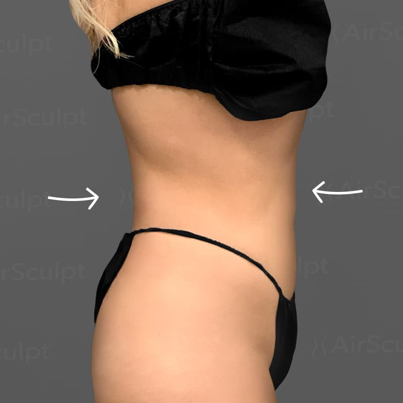Stomach AirSculpt after