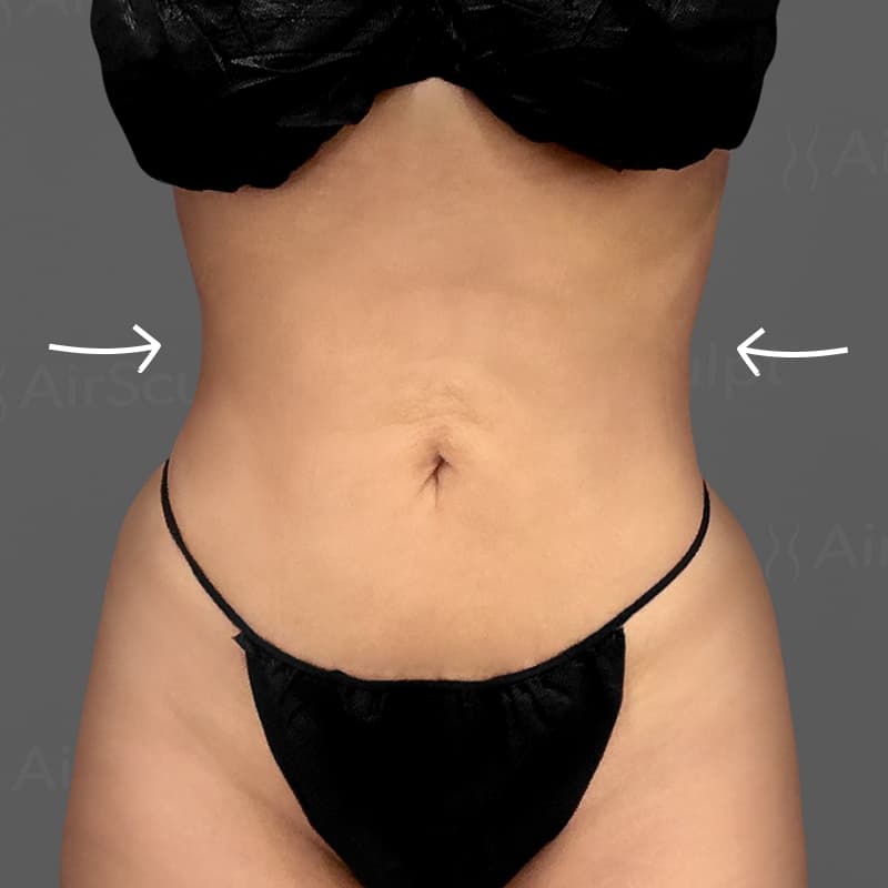 Stomach AirSculpt+ after